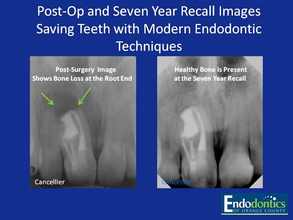 Successful Endodontic Cases Irvine, CA Endodontics of Orange County